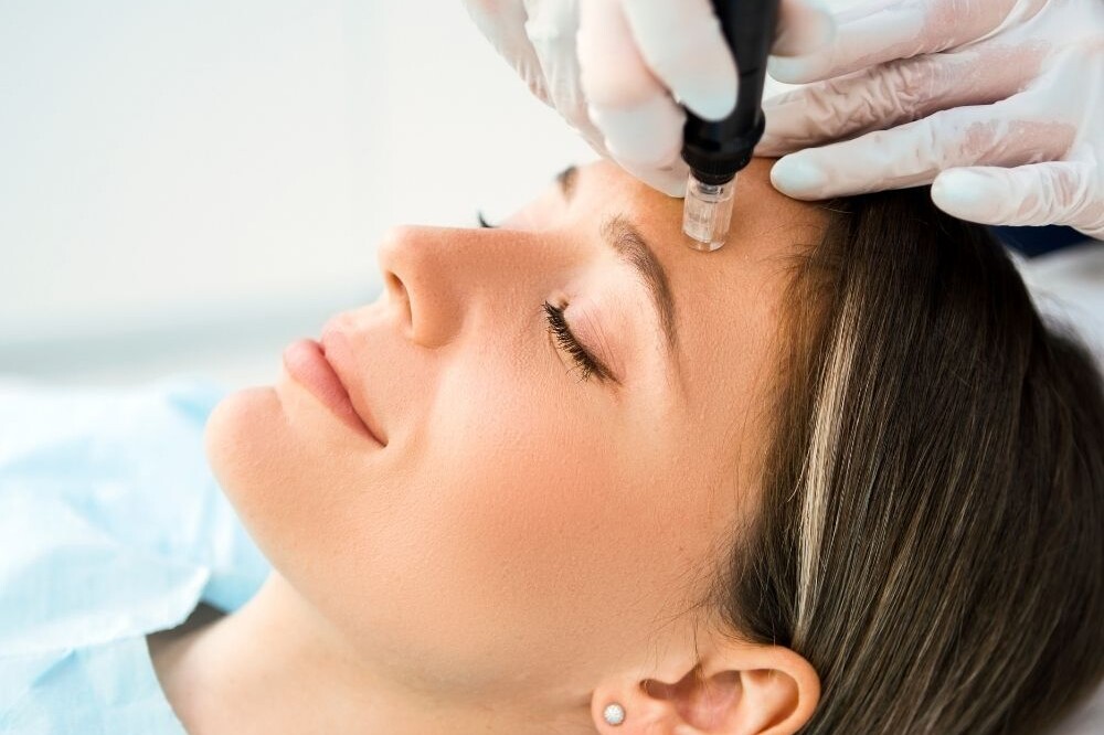 Mesoterapia facial con Dermapen