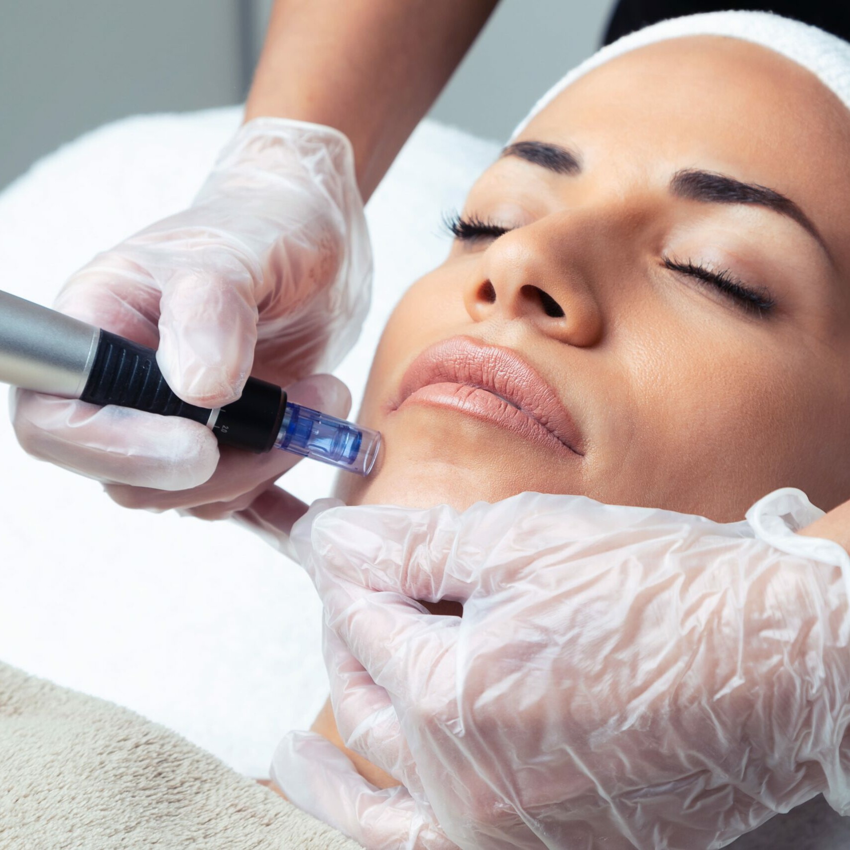 Mujer en cl&iacute;nica realiz&aacute;ndose tratamiento de exosomas y dermapen