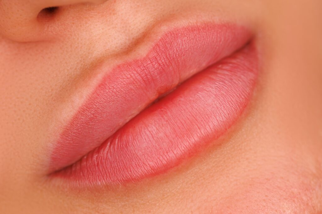 Resultado tras relleno de labios con ácido hialurónico