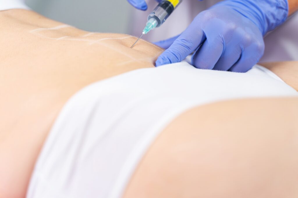Mesoterapia abdominal para combatir la flacidez abdominal
