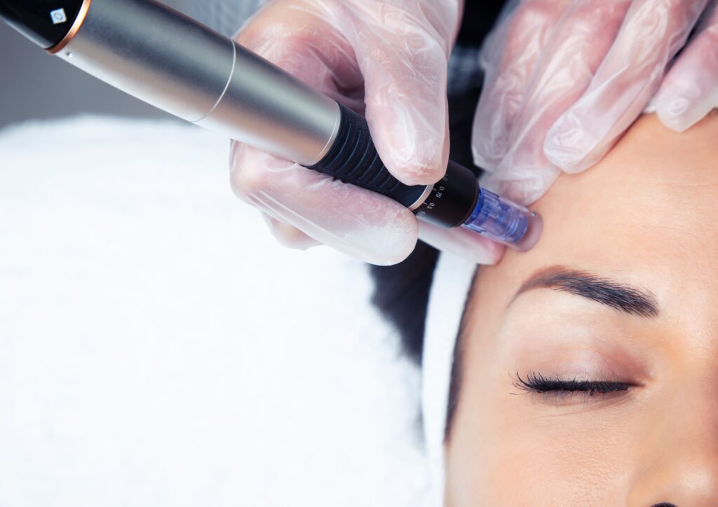 Tratamiento para combatir signos de envejecimiento facial: dermapen