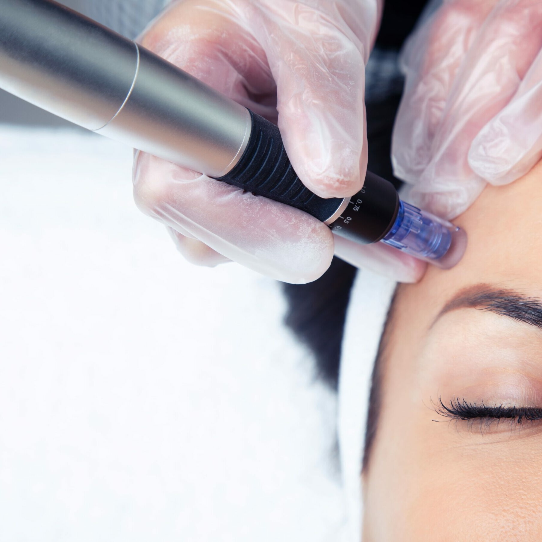 Tratamiento para combatir signos de envejecimiento facial: dermapen